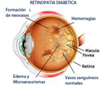 retinopatia